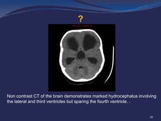 ?

Non contrast CT of the brain demonstrates marked hydrocephalus involving
the lateral and third ventricles but sparing the fourth ventricle. .

32

 