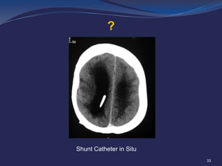 ?

Shunt Catheter in Situ
33

 