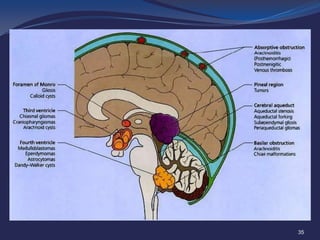 ?

Medulloblastoma: sagittal view MRI showing an avidly enhancing solid and
cystic lesion filling the fourth ventricle; obstructive hydrocephalus present
35

 