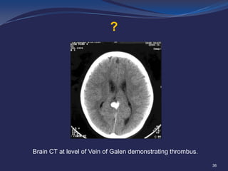 ?

Brain CT at level of Vein of Galen demonstrating thrombus.
36

 