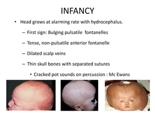 INFANCY
• Head grows at alarming rate with hydrocephalus.
– First sign: Bulging pulsatile fontanelles
– Tense, non-pulsatile anterior fontanelle
– Dilated scalp veins
– Thin skull bones with separated sutures
• Cracked pot sounds on percussion : Mc Ewans
sign
 