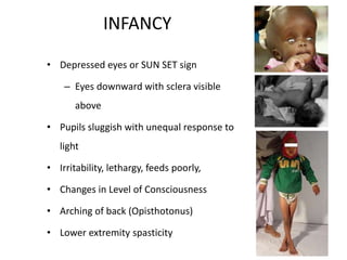 INFANCY
• Depressed eyes or SUN SET sign
– Eyes downward with sclera visible
above
• Pupils sluggish with unequal response to
light
• Irritability, lethargy, feeds poorly,
• Changes in Level of Consciousness
• Arching of back (Opisthotonus)
• Lower extremity spasticity
 
