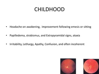 CHILDHOOD
• Headache on awakening, improvement following emesis or sitting
• Papilledema, strabismus, and Extrapyramidal signs, ataxia
• Irritability, Lethargy, Apathy, Confusion, and often incoherent
 