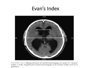 Evan’s Index
 