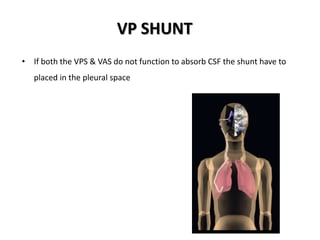 VP SHUNT
• If both the VPS & VAS do not function to absorb CSF the shunt have to
placed in the pleural space
 