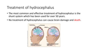 Hydrocephalus treatment; Reducing the infection rate by use of antimi…