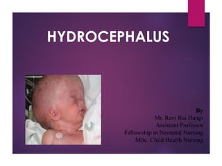 HYDROCEPHALUS
By
Mr. Ravi Rai Dangi
Assistant Professor
Fellowship in Neonatal Nursing
MSc. Child Health Nursing
 