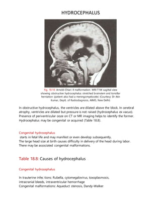 HYDROCEPHALUS
Fig. 18.10: Arnold-Chiari II malformation: MRI T1W sagittal view
showing obstructive hydrocephalus stretched brainstem and tonsillar
herniation (patient also had a meningomyelocele) (Courtesy: Dr Atin
Kumar, Deptt. of Radiodiagnosis, AIIMS, New Delhi)
In obstructive hydrocephalus, the ventricles are dilated above the block. In cerebral
atrophy, ventricles are dilated but pressure is not raised (hydrocephalus ex vacuo).
Presence of periventricular ooze on CT or MR imaging helps to identify the former.
Hydrocephalus may be congenital or acquired (Table 18.8).
Congenital hydrocephalus
starts in fetal life and may manifest or even develop subsequently.
The large head size at birth causes difficulty in delivery of the head during labor.
There may be associated congenital malformations.
Table 18.8: Causes of hydrocephalus
Congenital hydrocephalus
In trauterine infec tions: Rubella, cytomegalovirus, toxoplasmosis,
intracranial bleeds, intraventricular hemorrhage
Congenital malformations: Aqueduct stenosis, Dandy-Walker
 