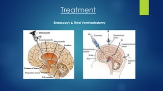 Treatment
Endoscopy & Third Ventriculostomy
 