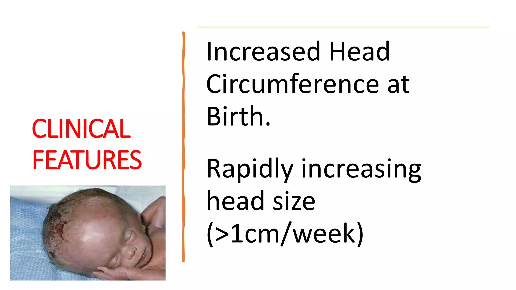CLINICAL
FEATURES
Increased Head
Circumference at
Birth.
Rapidly increasing
head size
(>1cm/week)
 