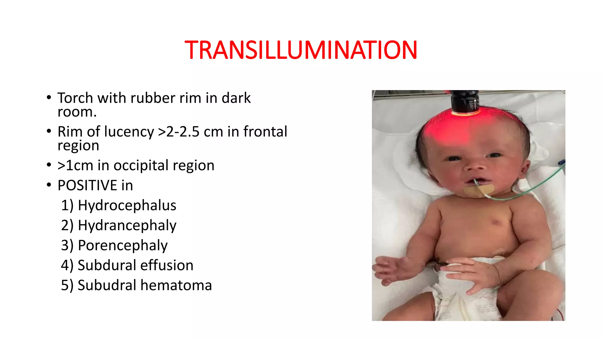 TRANSILLUMINATION
• Torch with rubber rim in dark
room.
• Rim of lucency >2-2.5 cm in frontal
region
• >1cm in occipital region
• POSITIVE in
1) Hydrocephalus
2) Hydrancephaly
3) Porencephaly
4) Subdural effusion
5) Subudral hematoma
 