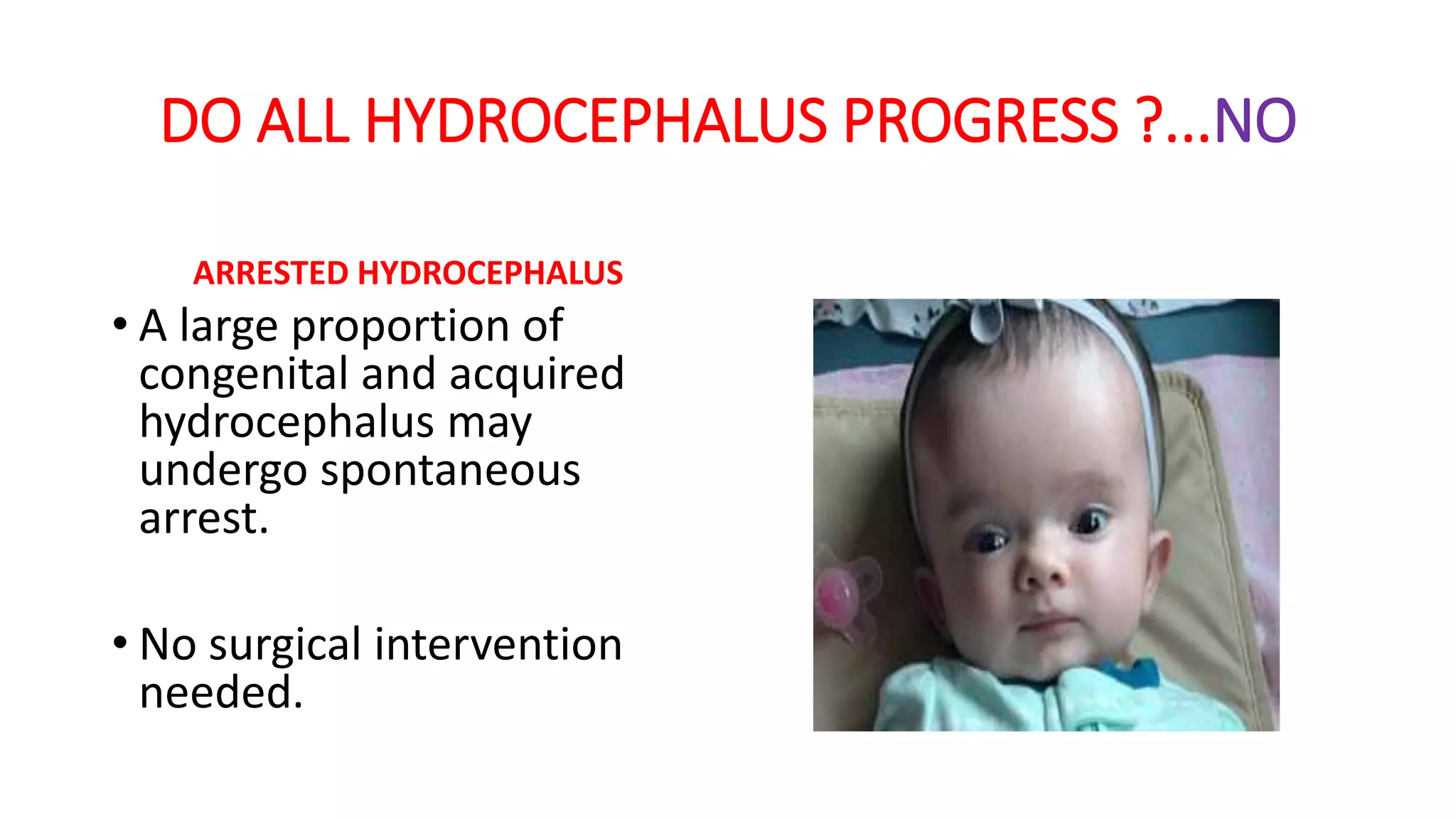 DO ALL HYDROCEPHALUS PROGRESS ?...NO
ARRESTED HYDROCEPHALUS
• A large proportion of
congenital and acquired
hydrocephalus may
undergo spontaneous
arrest.
• No surgical intervention
needed.
 