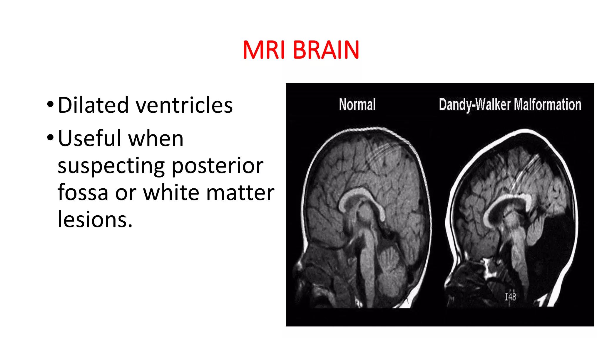 MRI BRAIN
•Dilated ventricles
•Useful when
suspecting posterior
fossa or white matter
lesions.
 