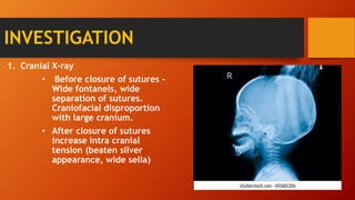 INVESTIGATION
1. Cranial X-ray
• Before closure of sutures -
Wide fontanels, wide
separation of sutures.
Craniofacial disproportion
with large cranium.
• After closure of sutures
increase intra cranial
tension (beaten silver
appearance, wide sella)
 