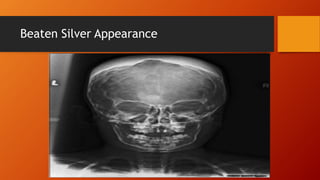 Beaten Silver Appearance
 