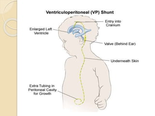 COMPLICATIONS
 Shunt block at ventricular or peritoneal
end
due to cell debris
 Malposition of ventricular end
 Displac...