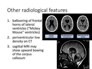 Other radiological features
1. ballooning of frontal
horns of lateral
ventricles (“Mickey
Mouse” ventricles)
2. periventricular low
density on CT
3. sagittal MRI may
show upward bowing
of the corpus
callosum
 