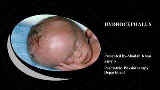 HYDROCEPHALUS
Presented by-Shadab Khan
MPT 2
Paediatric Physiotherapy
Department
 