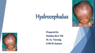 Hydrocephalus
Prepared by
Monika Devi NR
M. Sc. Nursing
GMCH Jammu
 