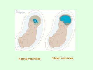 Normal ventricles Dilated ventricles
 