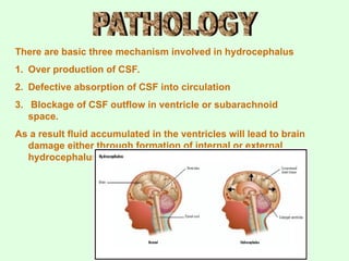There are basic three mechanism involved in hydrocephalus
1. Over production of CSF.
2. Defective absorption of CSF into circulation
3. Blockage of CSF outflow in ventricle or subarachnoid
space.
As a result fluid accumulated in the ventricles will lead to brain
damage either through formation of internal or external
hydrocephalus
 