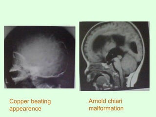 Copper beating
appearence
Arnold chiari
malformation
 