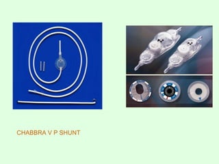 CHABBRA V P SHUNT
 