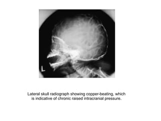 Lateral skull radiograph showing copper-beating, which is indicative of chronic raised intracranial pressure. 