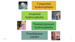 Congenital
hydrocephalus
Acquired
hydrocephalus
Normal pressure
hydrocephalus
Pseudotumor
cerebri
06-08-2021 35
 