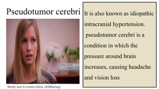 Pseudotumor cerebri
06-08-2021 42
Mostly seen in women (obese, childbearing)
It is also known as idiopathic
intracranial hypertension.
pseudotumor cerebri is a
condition in which the
pressure around brain
increases, causing headache
and vision loss
 