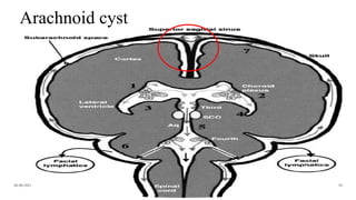 Arachnoid cyst
06-08-2021 50
 