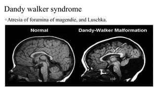 Dandy walker syndrome
◦Atresia of foramina of magendie, and Luschka.
06-08-2021 52
 