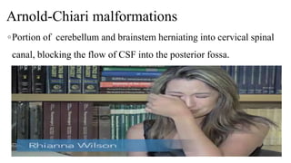 Arnold-Chiari malformations
◦Portion of cerebellum and brainstem herniating into cervical spinal
canal, blocking the flow of CSF into the posterior fossa.
06-08-2021 53
 