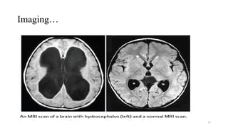 15
Imaging…
Head CT scan
• Fast, reliable, and does not interfere
with implanted medical devices.
• Usually can be accomplished
without sedation.
• Disadvantages - radiation exposure
MRI
• Modality of choice in patients with
unexplained hydrocephalus
• Superior visualization of
pathological processes in the CSF
pathway, including CSF flow
dynamics.
 