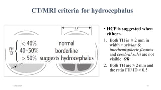11/06/2024 16
CT/MRI criteria for hydrocephalus
• HCP is suggested when
either:-
1. Both TH is ≥ 2 mm in
width + sylvian &
interhemispheric fissures
and cerebral sulci are not
visible OR
2. Both TH are ≥ 2 mm and
the ratio FH/ ID > 0.5
 