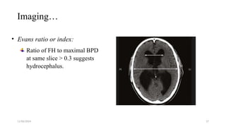 11/06/2024 17
Imaging…
• Evans ratio or index:
Ratio of FH to maximal BPD
at same slice > 0.3 suggests
hydrocephalus.
 
