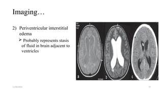11/06/2024 19
Imaging…
2) Periventricular interstitial
edema
 Probably represents stasis
of fluid in brain adjacent to
ventricles
 