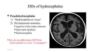 11/06/2024 22
DDx of hydrocephalus
 Pseudohydrocephalus
1) “Hydrocephalus ex vacuo”
2) Developmental anomalies
Agenesis of the corpus callosum
Septo-optic dysplasia
Hydranencephaly
How do you differentiate HCP from
“hydrocephalus ex vacuo” on imaging??
 
