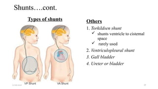 11/06/2024 29
Shunts….cont.
Types of shunts Others
1. Torkildsen shunt
 shunts ventricle to cisternal
space
 rarely used
2. Ventriculopleural shunt
3. Gall bladder
4. Ureter or bladder
 
