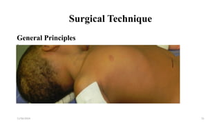 11/06/2024 31
Surgical Technique
General Principles
GA and endotracheal intubation
Supine with head turned to opposite side & neck extended.
Infection Avoidance (“shunt protocols”)
• Restrict personnel trafficking
• Prophylactic IV antibiotic
• Hair is clipped rather than shaved
• Antibiotics impregnated shunt system & suture materials
• Changing glove before shunt touching implants
 