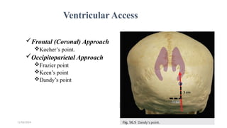 11/06/2024 33
Ventricular Access
Frontal (Coronal) Approach
Kocher’s point.
Occipitoparietal Approach
Frazier point
Keen’s point
Dandy’s point
 