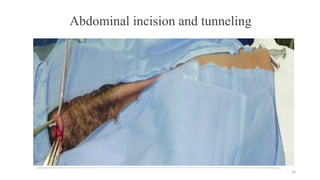 34
Abdominal incision and tunneling
 