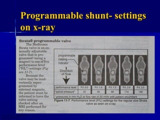 Hydrocephalus.Dr NG NeuroEdu | PPT