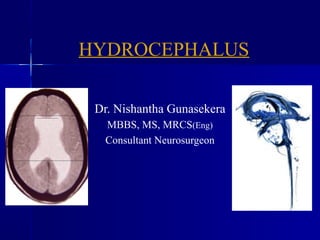 HYDROCEPHALUS

 Dr. Nishantha Gunasekera
  MBBS, MS, MRCS(Eng)
  Consultant Neurosurgeon
 