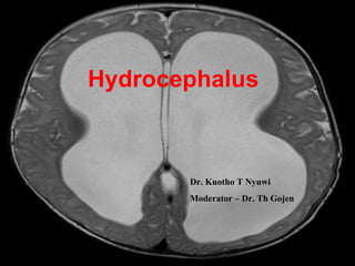Hydrocephalus
Dr. Kuotho T Nyuwi
Moderator – Dr. Th Gojen
 