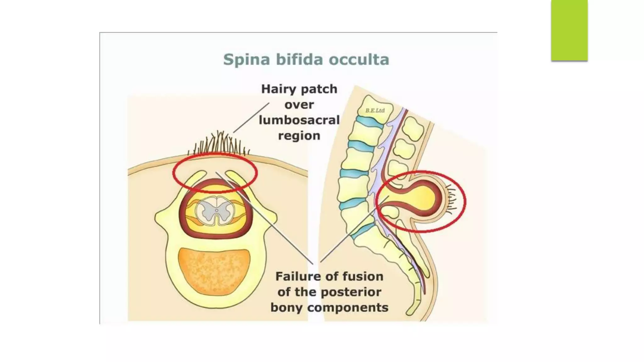 Hydrocephalus , Spina Bifida and craniosynotosis | PPT