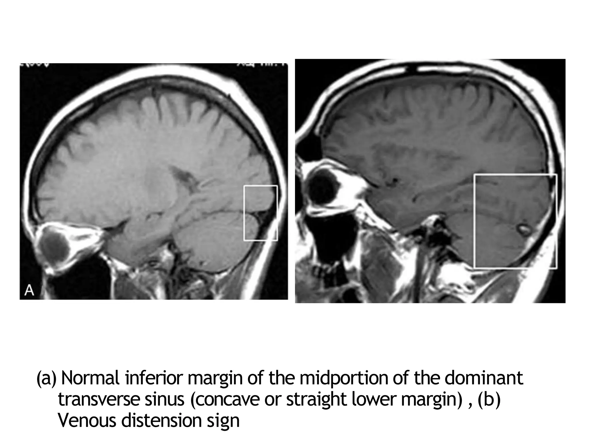 hydrocephalus and csf disorders powerpoint | PPTX