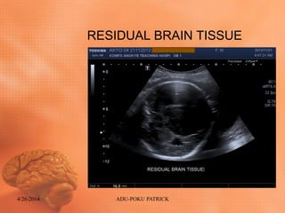 RESIDUAL BRAIN TISSUE
4/26/2014 ADU-POKU PATRICK
 
