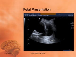 Fetal Presentation
4/26/2014 ADU-POKU PATRICK
 