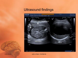 Ultrasound findings
4/26/2014 ADU-POKU PATRICK
 